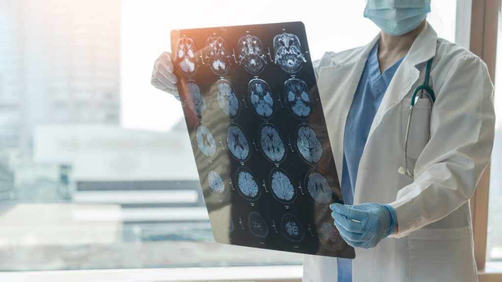 Doctor reviewing records in a delayed stroke diagnosis malpractice case